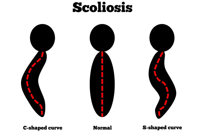 Wolverton, Milton Keynes scoliosis treatment